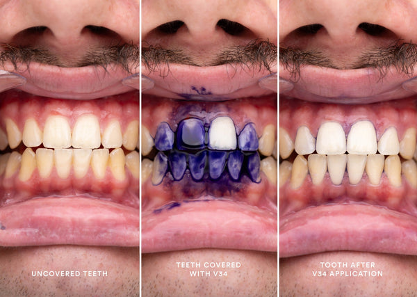 🦷 Dientes Ultra Blancos 😁 + 🎁 Lápiz Blanqueador Gratis